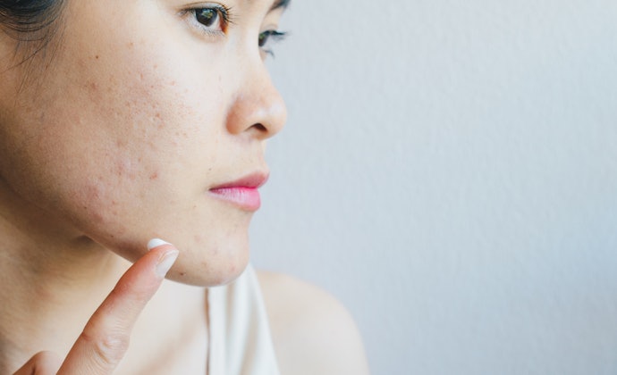 Nguyên Nhân Gây Thâm Mụn Là Gì?