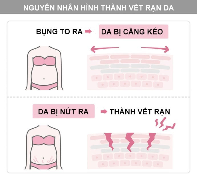 Vết Rạn Da Là GÌ? Cách Phòng Ngừa Vết Rạn Da