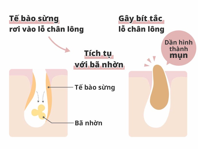 Mụn Đầu Đen Là Gì? Miếng Lột Mụn Có giúp Giải Quyết Triệt Để?