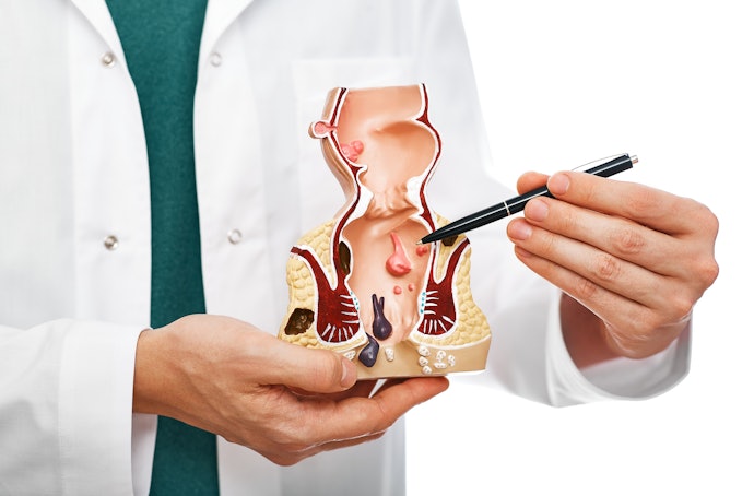 Bệnh Trĩ Là Gì? Nguyên Nhân Gây Bệnh Trĩ?