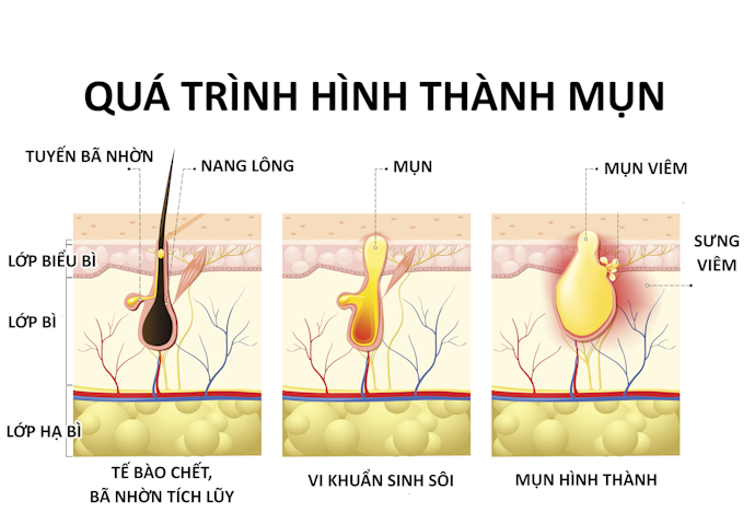 Nguyên Nhân Hình Thành Mụn