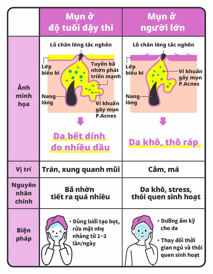 Nguyên Nhân Gây Mụn Ở Tuổi Teen Và Người Lớn Là Khác Nhau
