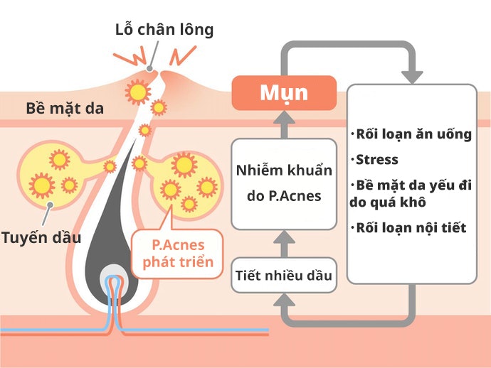 Nguyên Nhân Gây Mụn Là Gì?