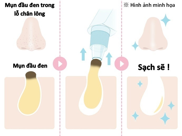 Công Dụng Của Máy Hút Mụn Đầu Đen