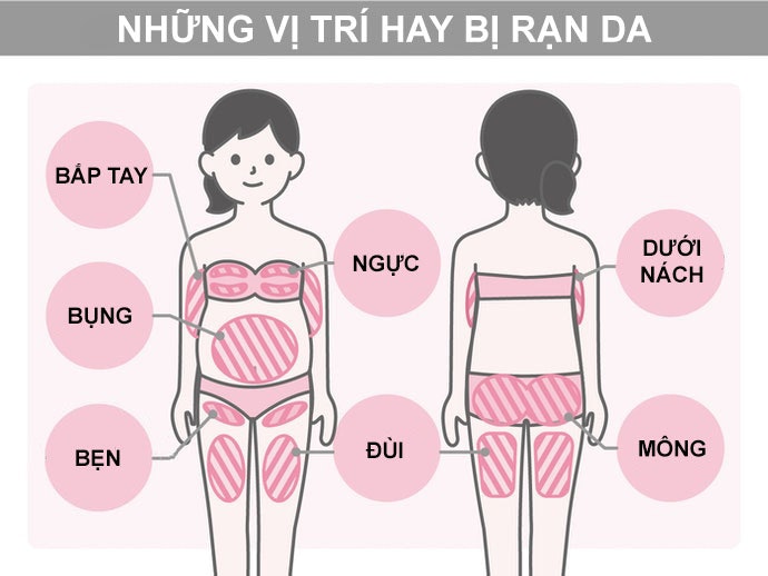 Vết Rạn Da Xuất Hiện Tại Những Bộ Phận Nào?