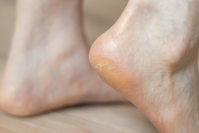 Gót Chân Khô Dày Sừng, Vàng Gót: Chọn Nồng Độ Salicylic Trên 5%
