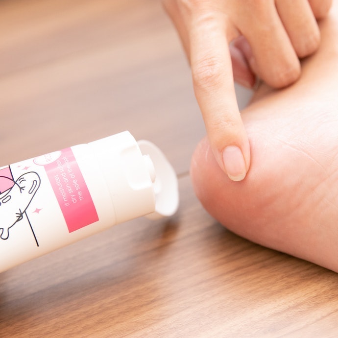 Gót Chân Khô Nhiều, Vết Nứt Hở: Dùng Kem Có Nồng Độ Urea 10 - 40%