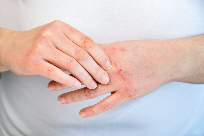 Chọn Dược Mỹ Phẩm Nếu Da Khô, Nứt Nẻ Nghiêm Trọng
