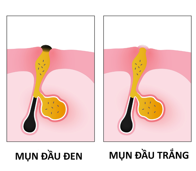 Da Mụn Ẩn, Mụn Đầu Đen: Chọn Thành Phần Giúp Tẩy Tế Bào Chết, Làm Sạch Bã Nhờn