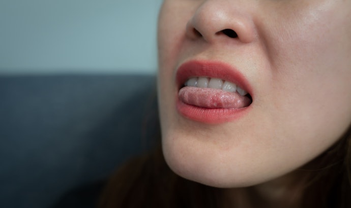 Bị Nhiệt Miệng Nặng, Lâu Ngày Không Khỏi: Cân Nhắc Thuốc Chứa Corticosteroid Tại Chỗ Như Triamcinolone Acetonide