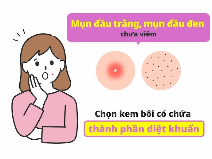 Mụn Đầu Trắng, Mụn Đầu Đen: Chọn Kem Chứa Thành Phần Diệt Vi Khuẩn Gây Mụn