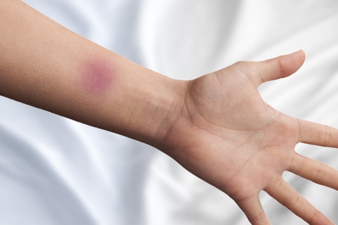 Vết Bầm Tím Là Gì?