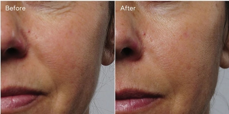 Rapid Collagen Infusion 2