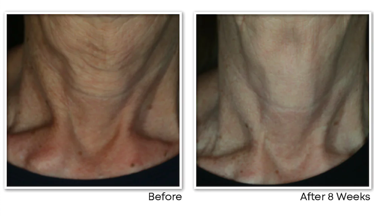Kem Dưỡng Da Cổ RoC Multi Correxion Crépe Repair Face & Neck Cream 2