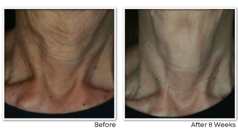 Kem Dưỡng Da Cổ RoC Multi Correxion Crépe Repair Face & Neck Cream 2