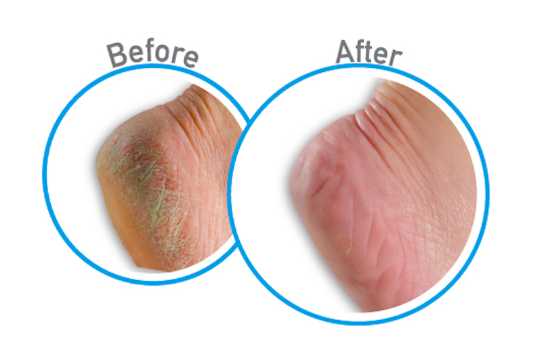 Kem Trị Nứt Gót Chân O’Keeffe’s Healthy Feet 4