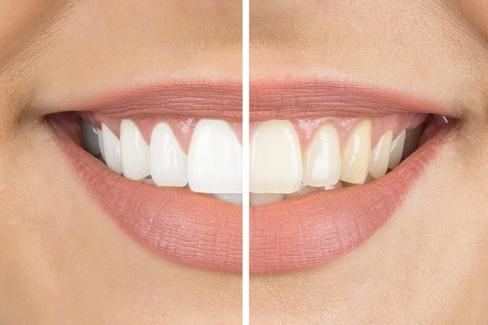 Kiểm Tra Sự Khác Biệt Trong Chức Năng Làm Trắng Răng!