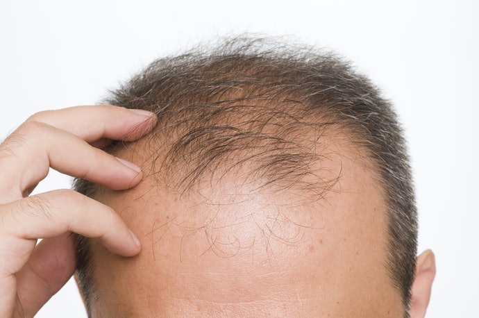 Tóc Khó Mọc: Chọn Thuốc Thúc Đẩy Sự Phát Triển Của Tóc